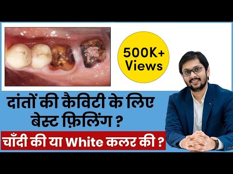 How to remove tooth cavities? Tooth Cavity Treatment in Hindi | Tooth Cavity Pain Treatment in Hindi