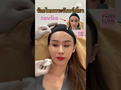 ร้อยไหม หน้าเรียว
