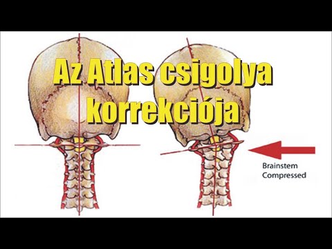 Coxarthrosis gonarthrosis artroxis kis ízületek