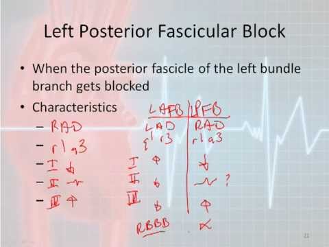 12 Lead Interpretation Part 4-2: Bundle Branch and Fascicular Blocks