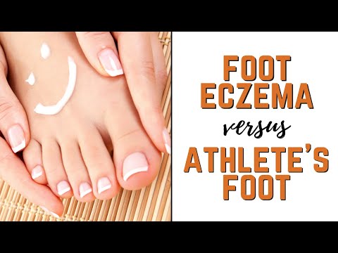 Types of Foot Eczema vs. Athlete's Feet: Symptoms, Causes & Natural Treatments