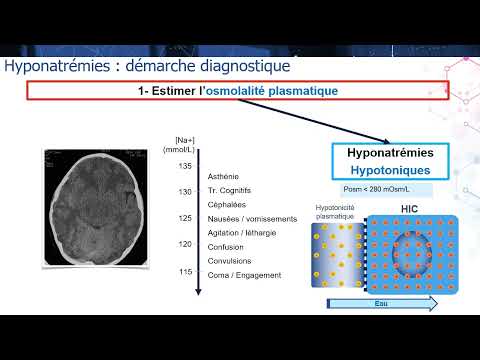 6 37 2 Hyponatremia - diagnostic approach, etiological diagnosis, management