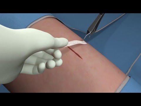 Técnica de Aplicação de Steri Strip - Sutura Cutânea Adesiva