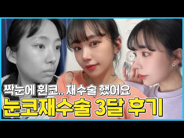 더 예쁘게, 에이비성형외과 이벤트 더 예쁘게, 에이비성형외과 이벤트
