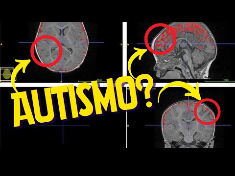Por que imagens do cérebro NÃO diagnosticam o Autismo?