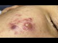 Satisfying With Loan Nguyen Spa Video (#064) #acnetreatment