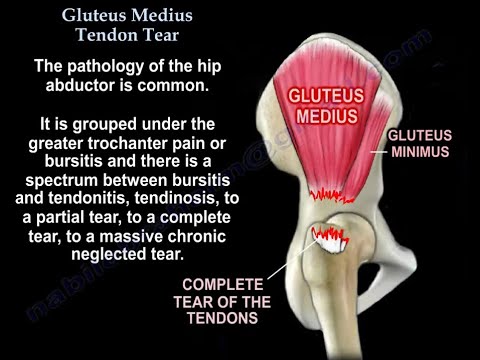 Gluteus Medius Tendon Tear, diagnosis and treatment.