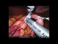 『達文西手術』減肥手術 Robotic assisted sleeve gastrectomy