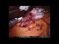 『達文西手術』減肥手術 Robotic assisted sleeve gastrectomy