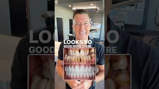 Full Mouth Dental Implants performed in just One Single Visit to Innovative Dental Implant Center!