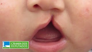 Fissura Labiopalatina atinge uma em cada 650 crianças nascidas no Brasil - 4/06/25