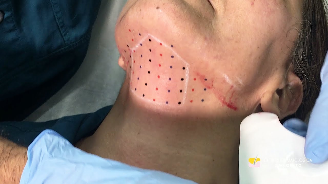 Reducción de la papada sin cirugía