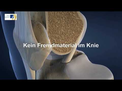 Knie OP bei Kreuzbandriss | 3D-Animation Kniegelenk