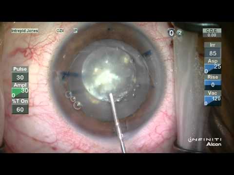 Catalys Femtosecond Laser Cataract Surgery