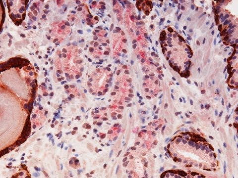 Soda Behandlung von Prostata-Adenom Vitaprost Pillen in Novosibirsk kaufen