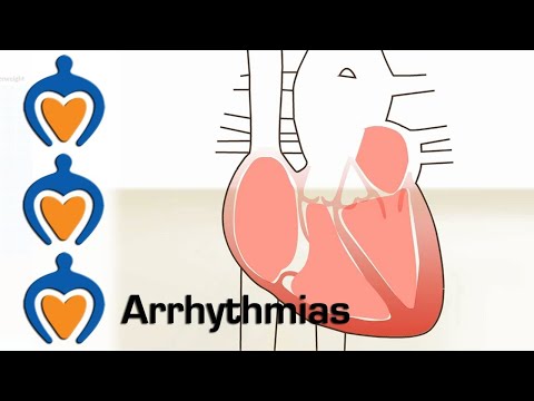 Arrhythmia overview | Types , Diagnosis and treatment |