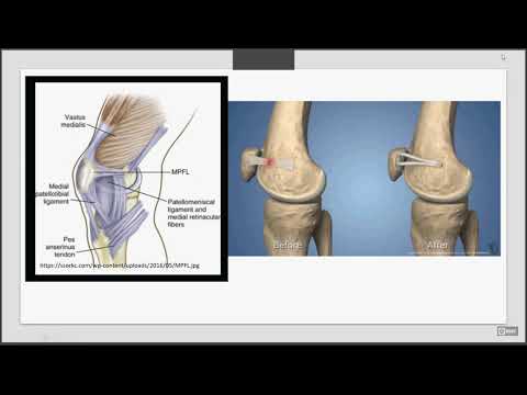 Artroza deformantă a gradului 3 al articulației gleznei
