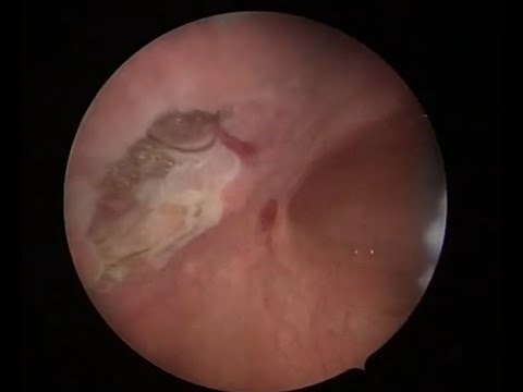 Endoscopic removal of malignant bladder tumor thumbnail