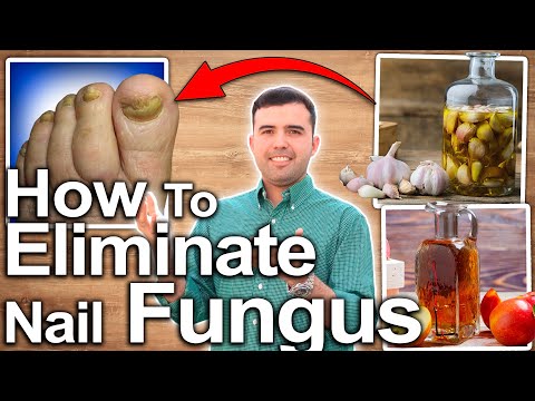 5 Home Remedies for Toenail Fungus - Toe Fungus Journey - YouTube