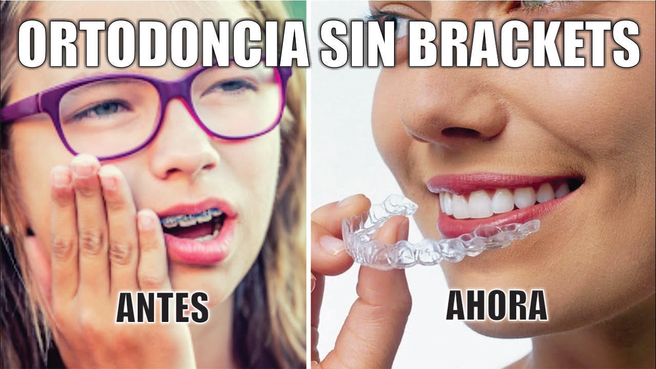 ORTODONCIA INVISIBLE SIN BRACKETS 🦷 Precio INVISALIGN PERU 🤩 SANTIAGO BURGA 3D digital dental design