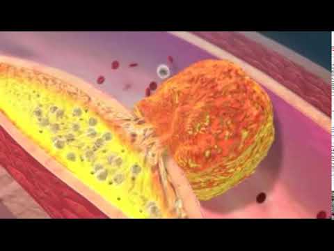 Plaque Rupture
