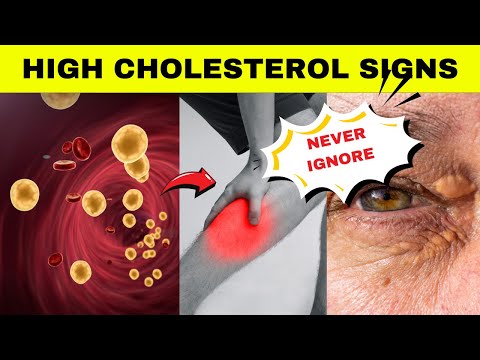 These Signs Tell You That You Have High Blood Cholesterol |Warning Signs Of High Blood Cholesterol