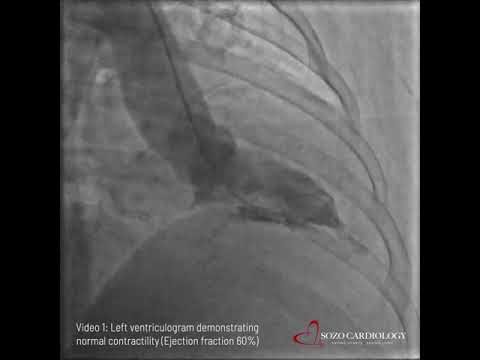 Video 1: Left ventriculogram demonstrating normal contractility Ejection fraction 60%