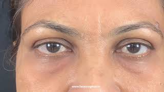 How To Get Rid Of Tired Eyes and Swollen Eyelids ? Scar Less Fat Removal Surgery