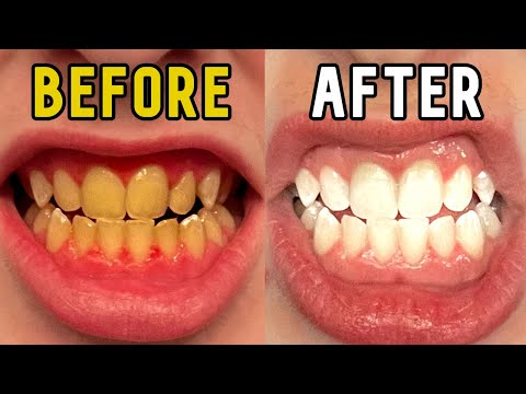 How I Whitened My Teeth in 14 Days!
