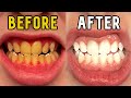 How I Whitened My Teeth in 14 Days!