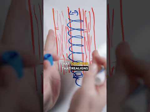 Day 26: Is Muscle Repair of Diastasis Permanent?