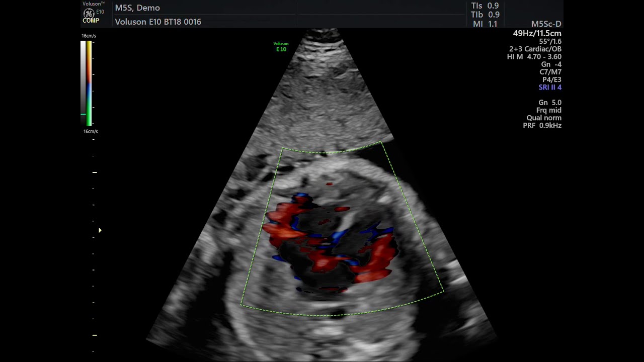 DOPPLER CARDIACO COLORIDO