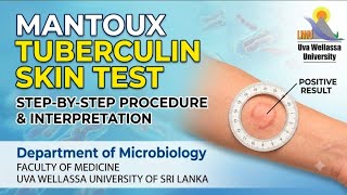 Mantoux test