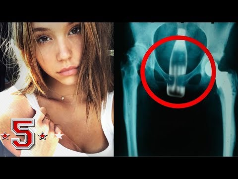 Il prurito di passaggio posteriore è provocato da parassiti Definizione un tsist di lyambliya in acqua potabile