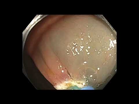 Coloscopie: mucosectomie endoscopique d'un polype festonné sessile du caecum