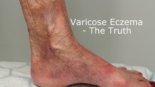 Varicose Eczema - The Truth about the causes and treatment that can prevent leg ulcers