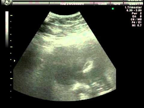 Ultrasound - 12/23/2010