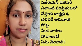 సిజేరియన్ ఎప్పుడు చెస్తరు డాక్టర్లు.అలాగే strech marks పోవాలంటే ఎంచేయాలి?#sudhitalks #pregnancy