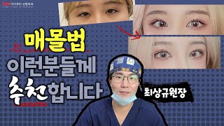 매몰법 하면 좋은 눈? #쌍꺼풀수술 각 #아이루미