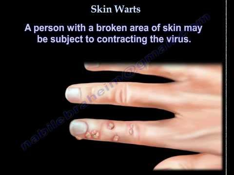 Skin Warts , Hand warts - Everything You Need To Know - Dr. Nabil Ebraheim