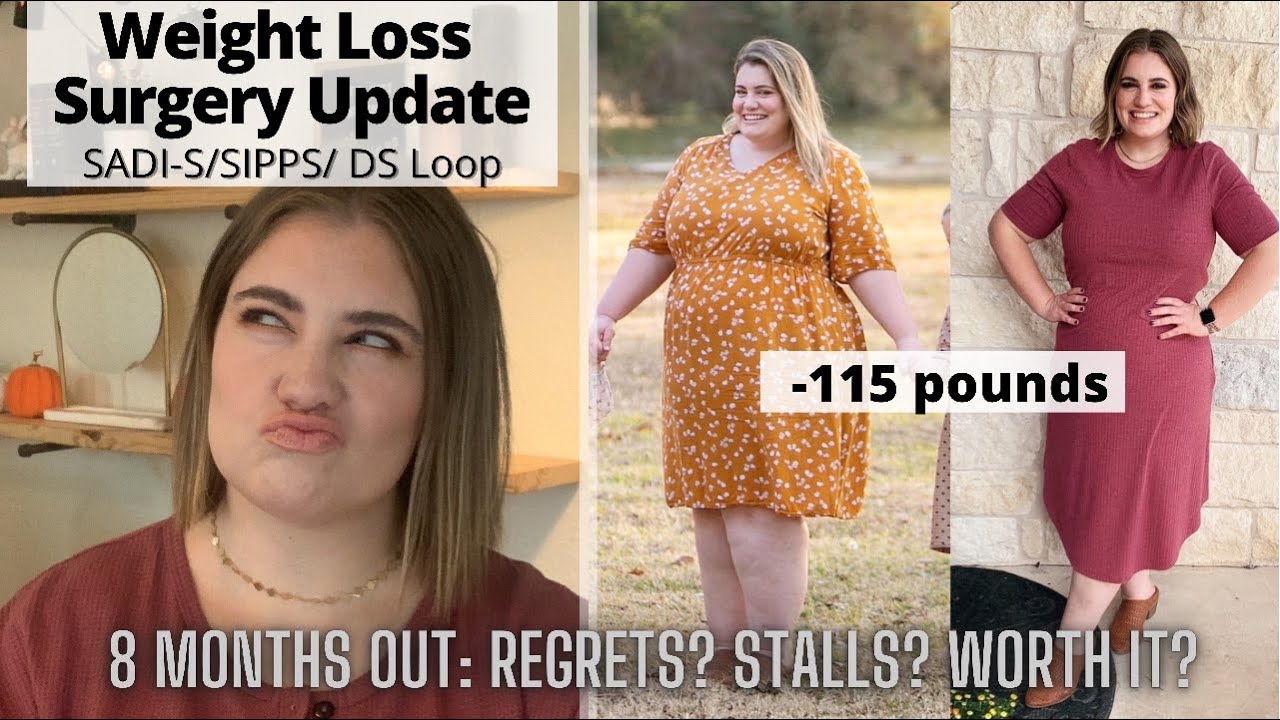 Weight Loss Surgery 8 Month Update (SADI-S/ SIPPS/ Modified Duodenal Switch/ DS Loop)