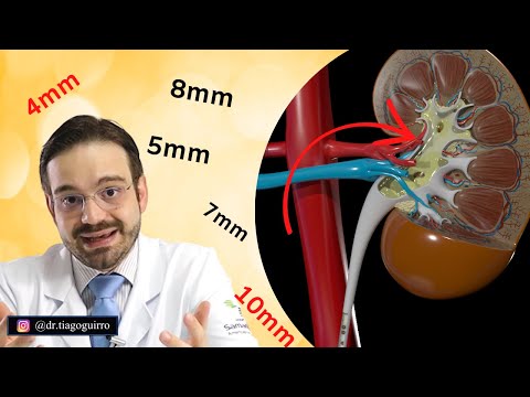 Expelir Cálculo Renal Sem Cirurgia! É Possível!?