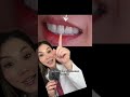 The dreaded black triangle and how to get rid of it. #blacktriangle #dentist #dentistry #filling