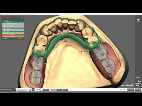 BEGO WIRONIUM® RP Complete – Exocad Design Tutorial