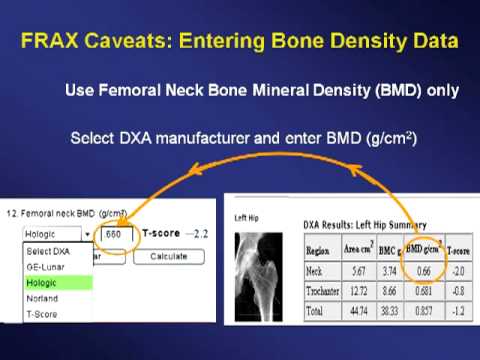 Identifying Women Who Need Osteoporosis Therapy Update on Fracture Risk Assessment