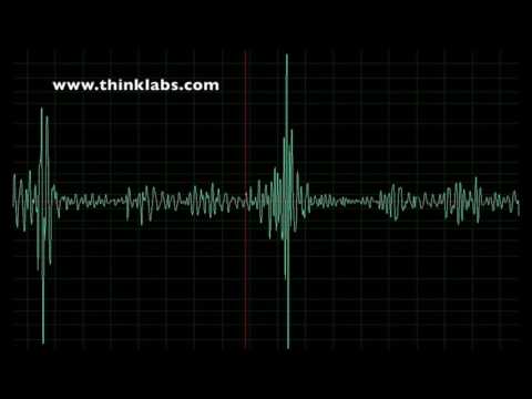 Mitral Stenosis- rheumatic
