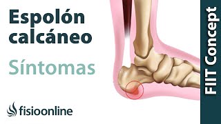 Causas y síntomas del espolón calcáneo