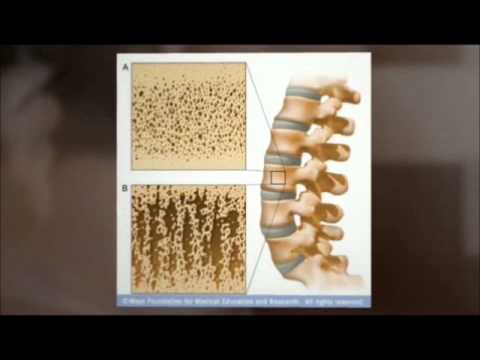 INSTITUTO NACIONAL DE OSTEOPOROSIS