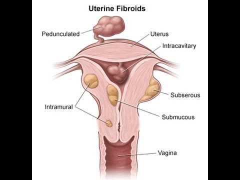 Uterine Fibroids Types and Treatments : Intramural, Submucosal and Subserosal Fibroid.