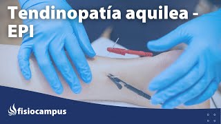 Tendinopatía aquilea: tratamiento con la técnica EPI - teoría
